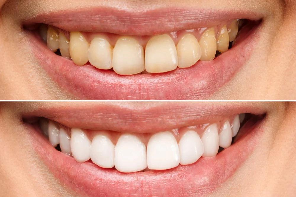 cand poti apela la fatete dentare