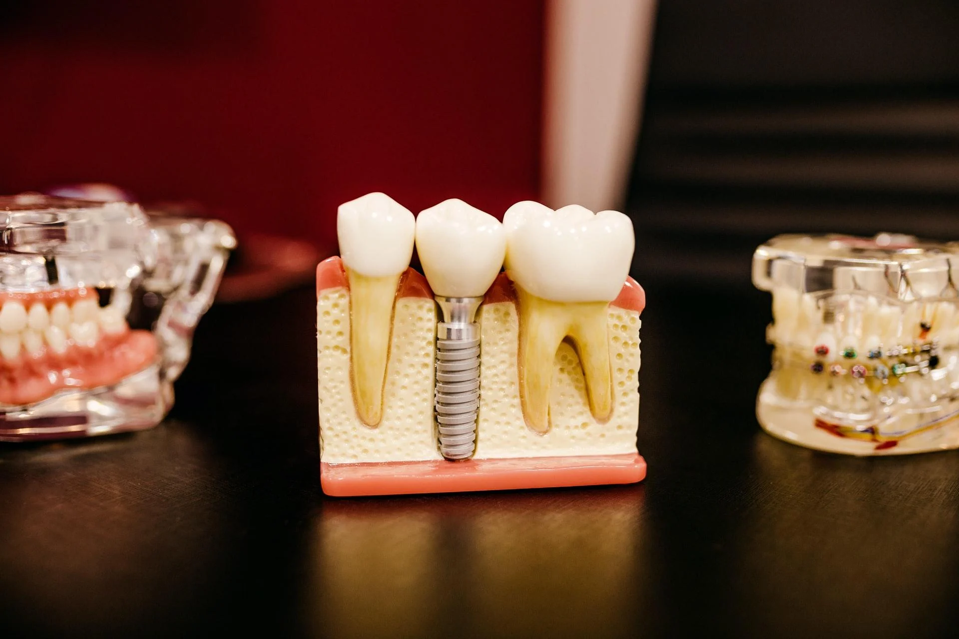 cand se recomanda implantul dentar