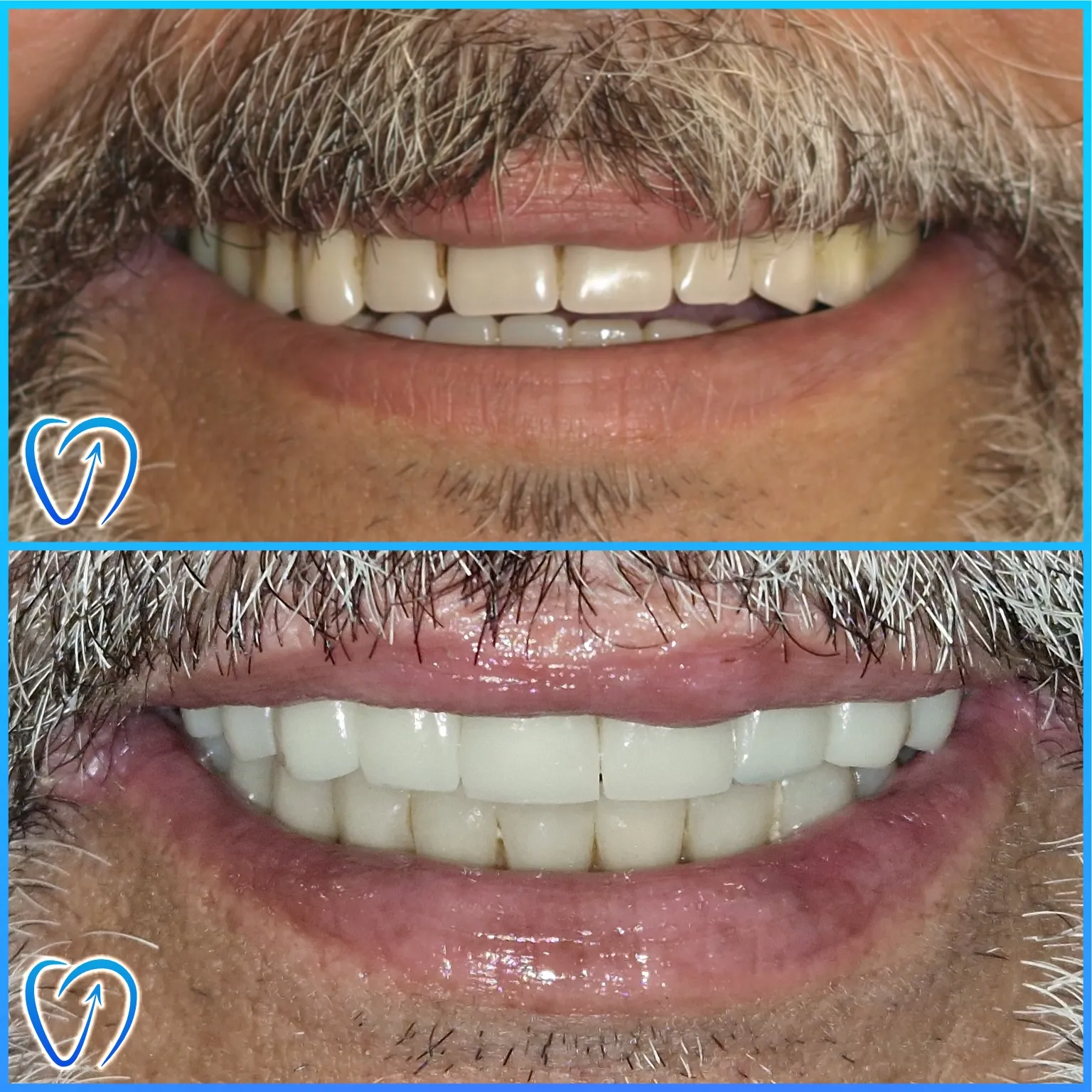 caz 1 reabilitare completa implanturi dentare 003