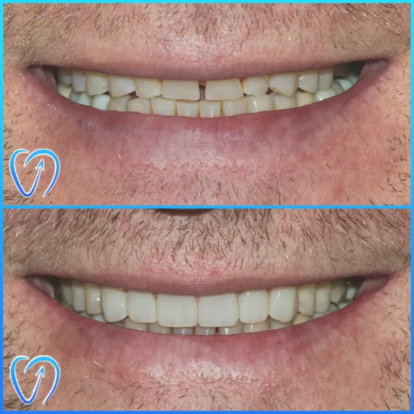 caz clinic fatete dentare si coroane zirconiu EXCEDENT Bucuresti