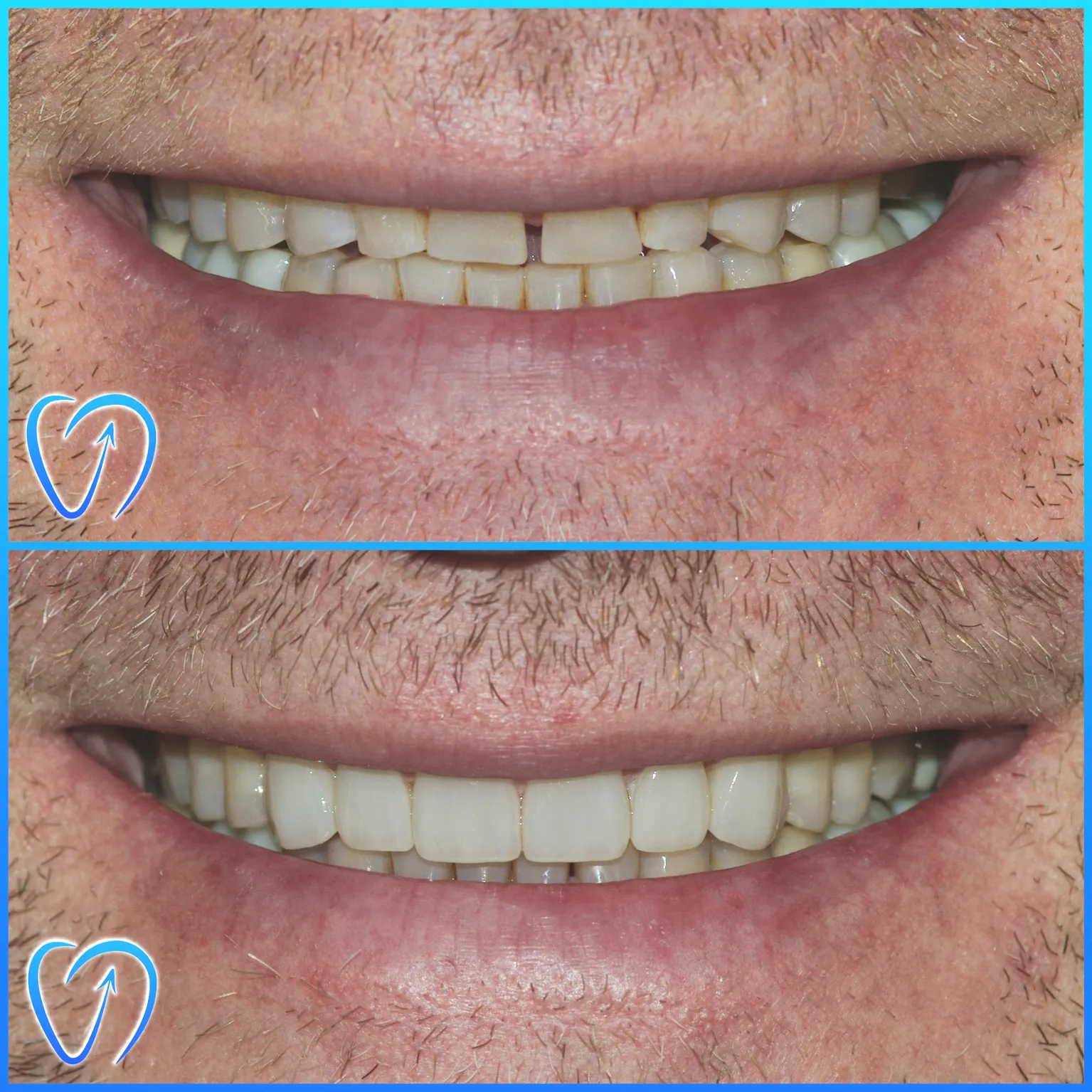 caz clinic fatete dentare si coroane zirconiu EXCEDENT Bucuresti