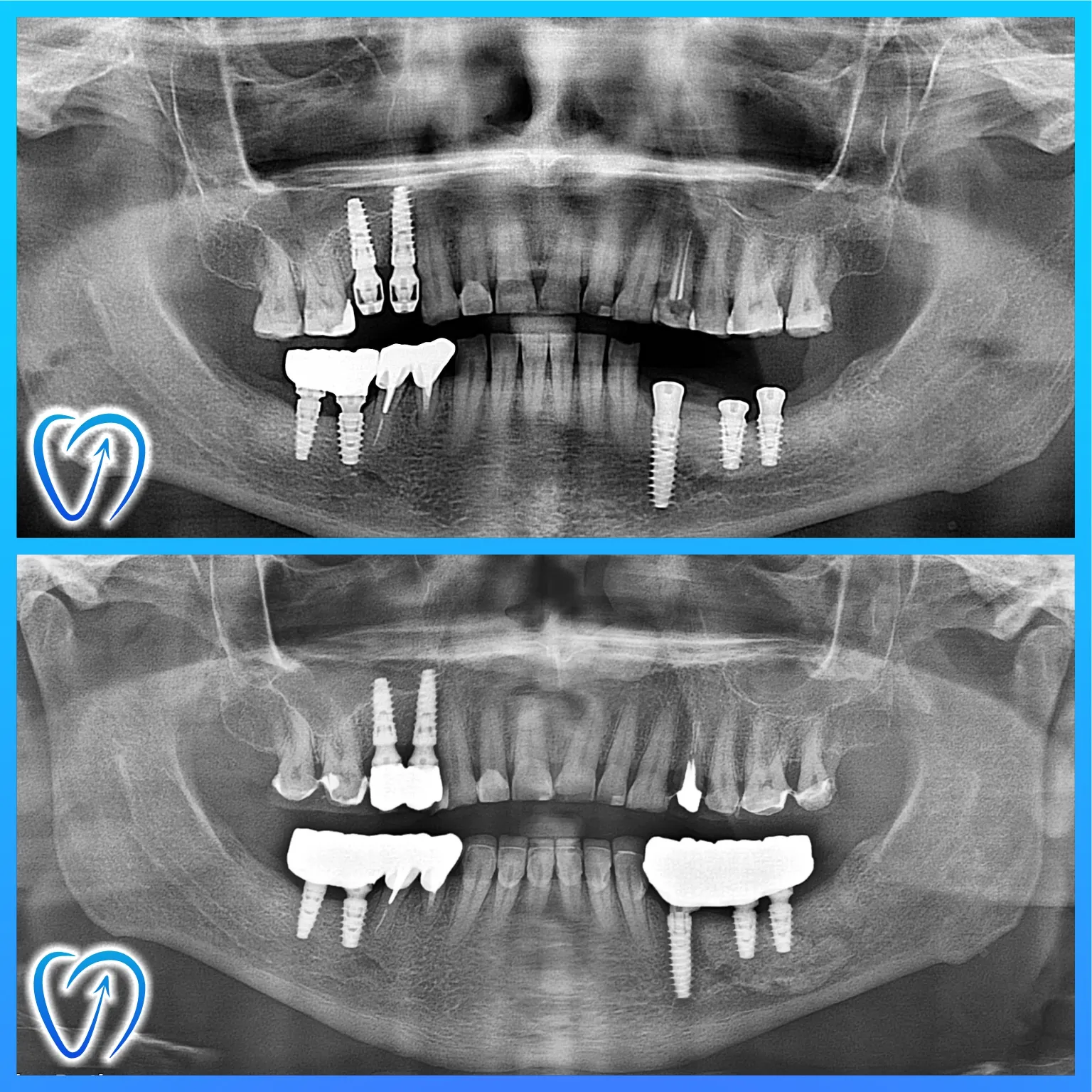 caz 3 tratament dentar integral coroane zirconiu fatete dentare 001