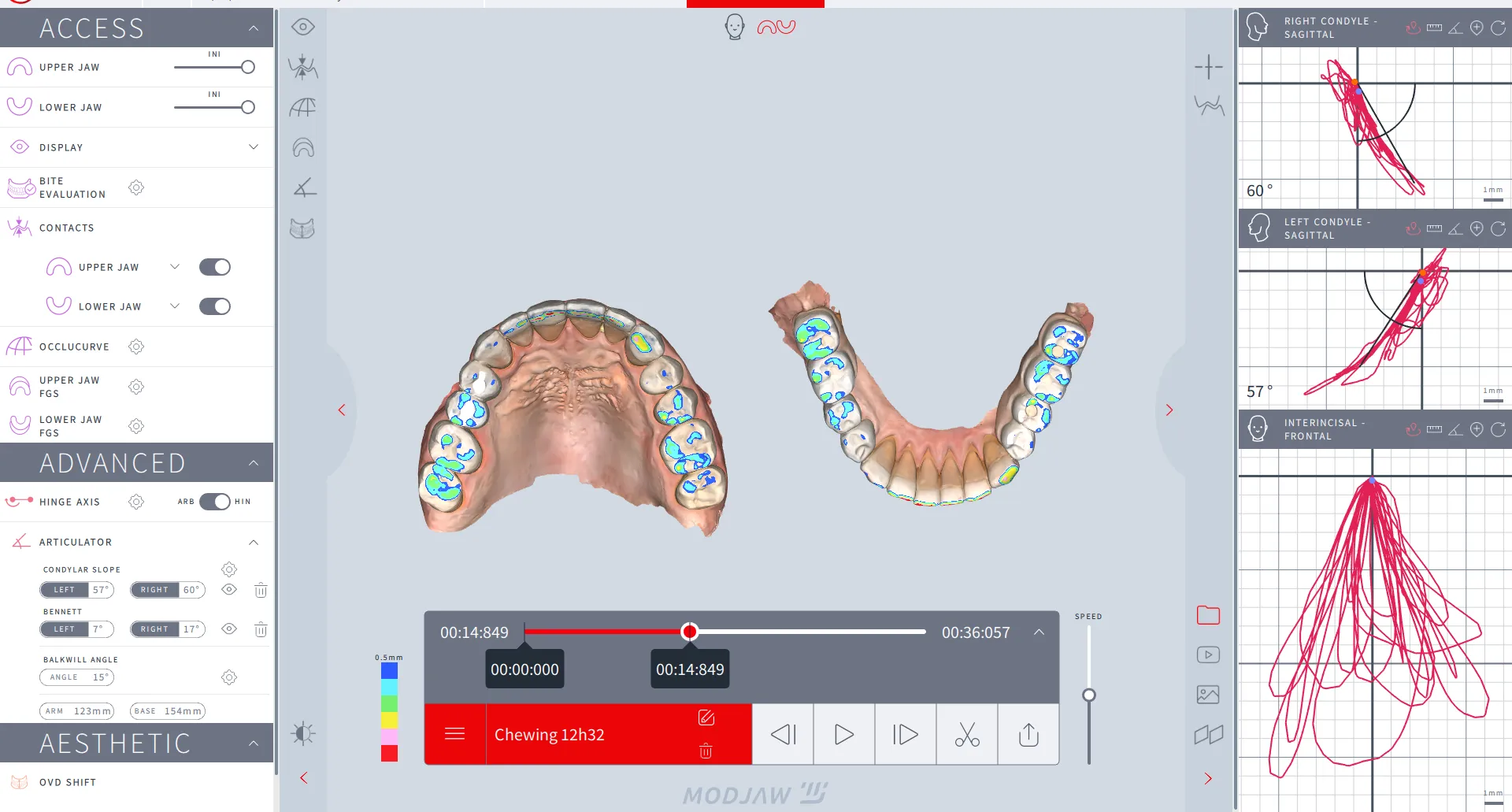 caz 3 tratament dentar integral coroane zirconiu fatete dentare 002