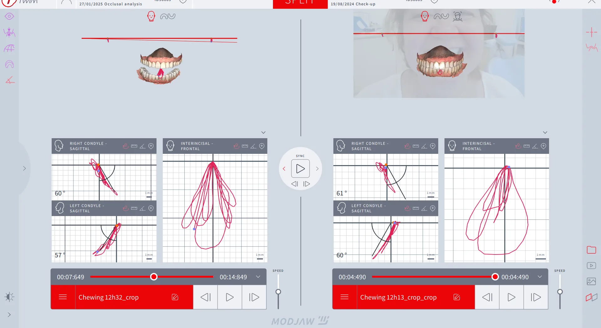 caz 3 tratament dentar integral coroane zirconiu fatete dentare 003