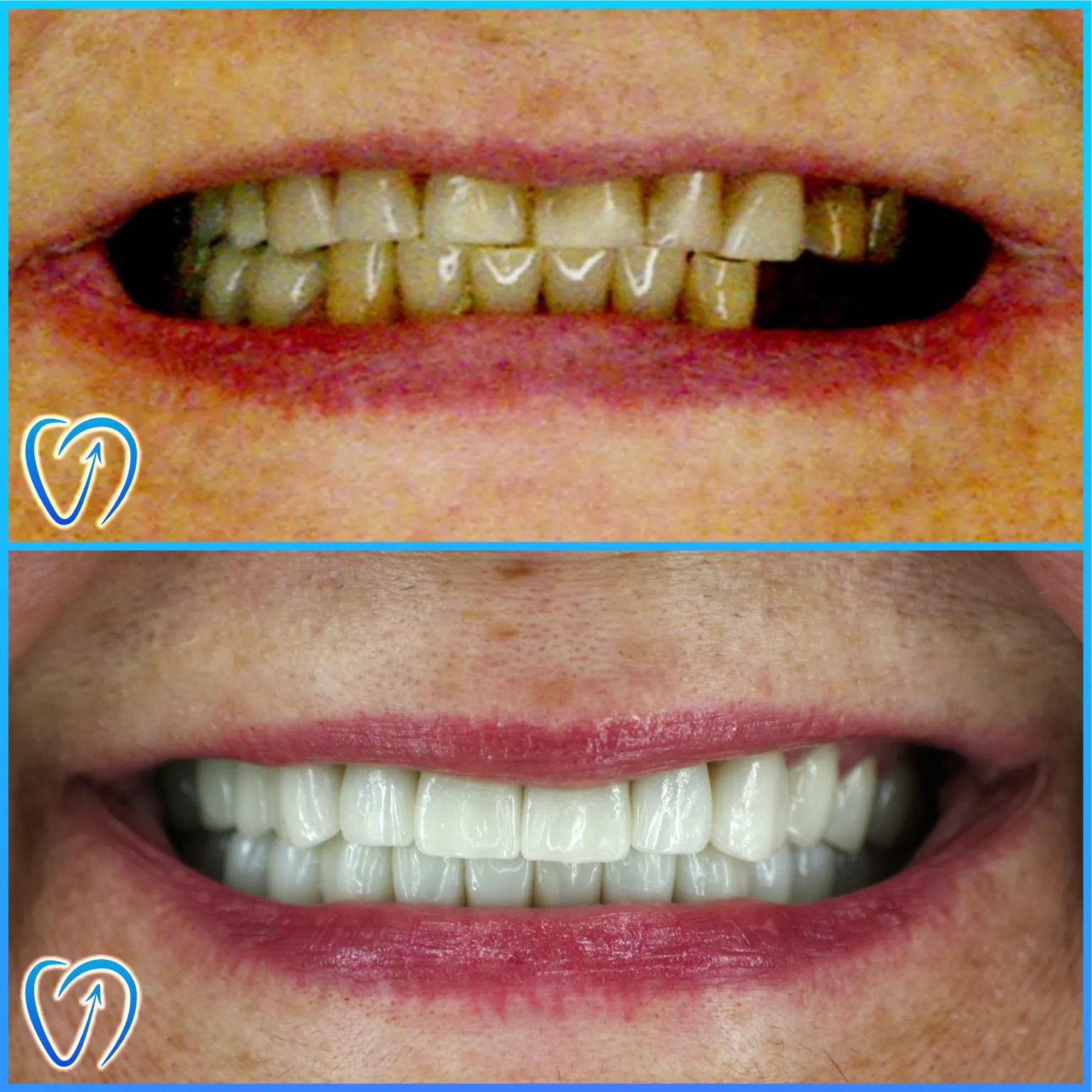 caz 3 tratament dentar integral coroane zirconiu fatete dentare 004