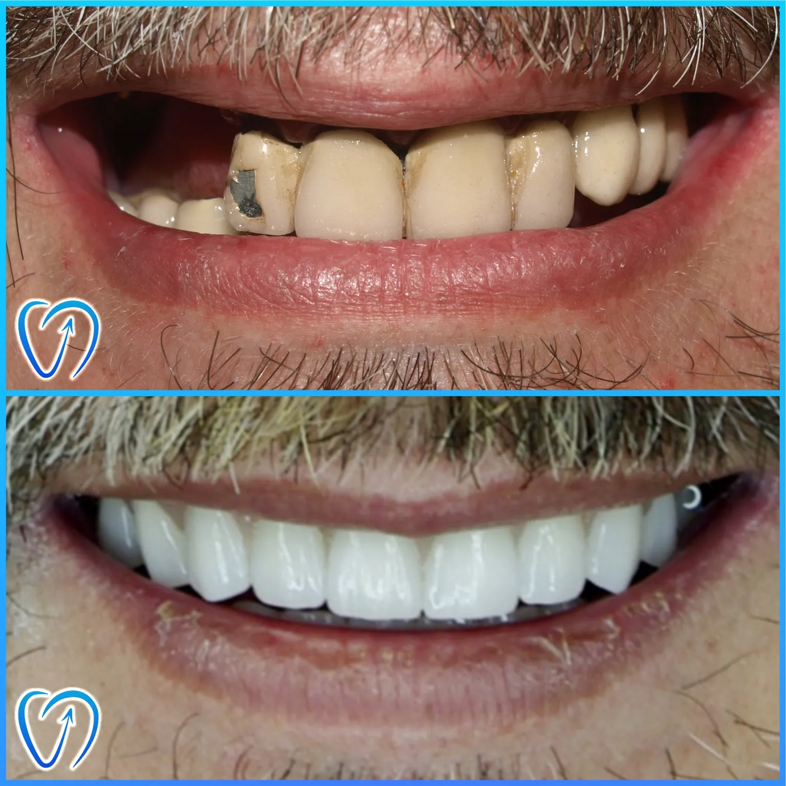 caz 4 implanturi dentare coroane din zirconiu 003