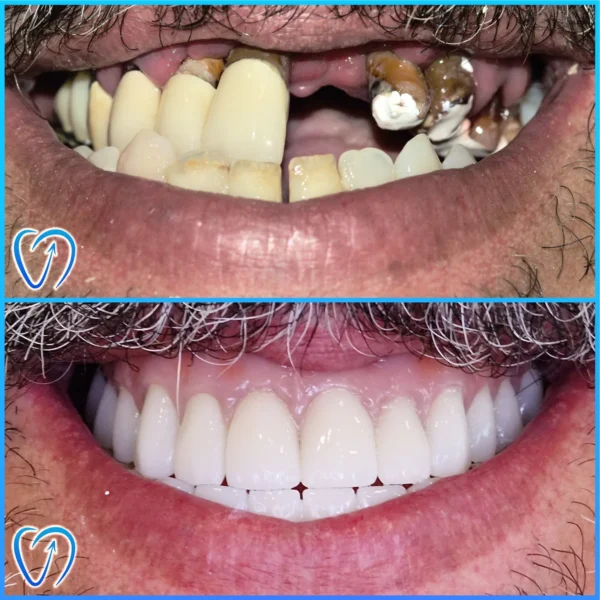 caz clinic reabilitare orala completa cu implanturi si coroane dentare inainte si dupa tratament EXCEDENT Bucuresti