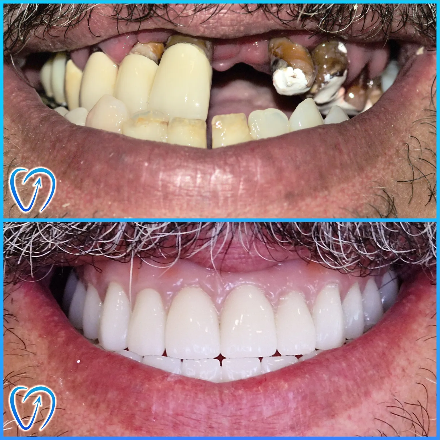 caz clinic reabilitare orala completa cu implanturi si coroane dentare inainte si dupa tratament EXCEDENT Bucuresti