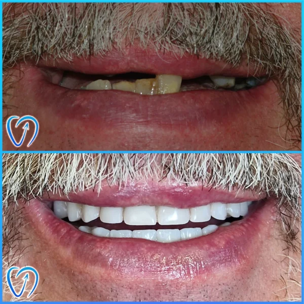 caz clinic implanturi dentare pentru afectiune congenitala EXCEDENT