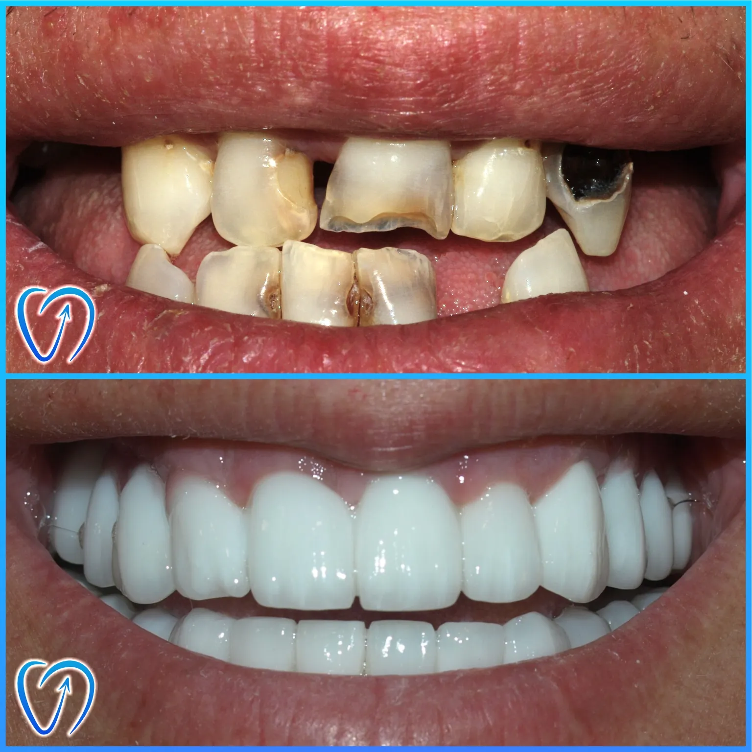 caz clinic reabilitare dentara cu implanturi Zimmer si coroane zirconiu