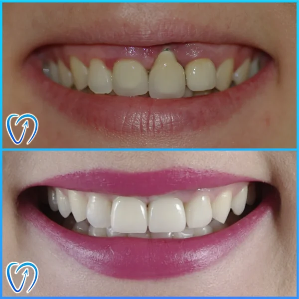 caz clinic tratament complex pe implant dentar si coroane zirconiu