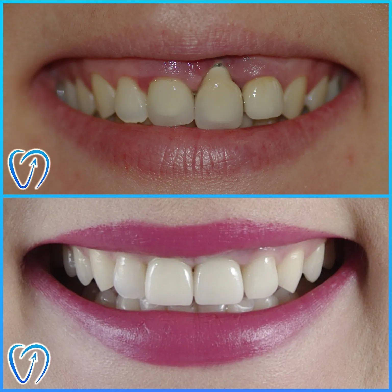 caz clinic tratament complex pe implant dentar si coroane zirconiu