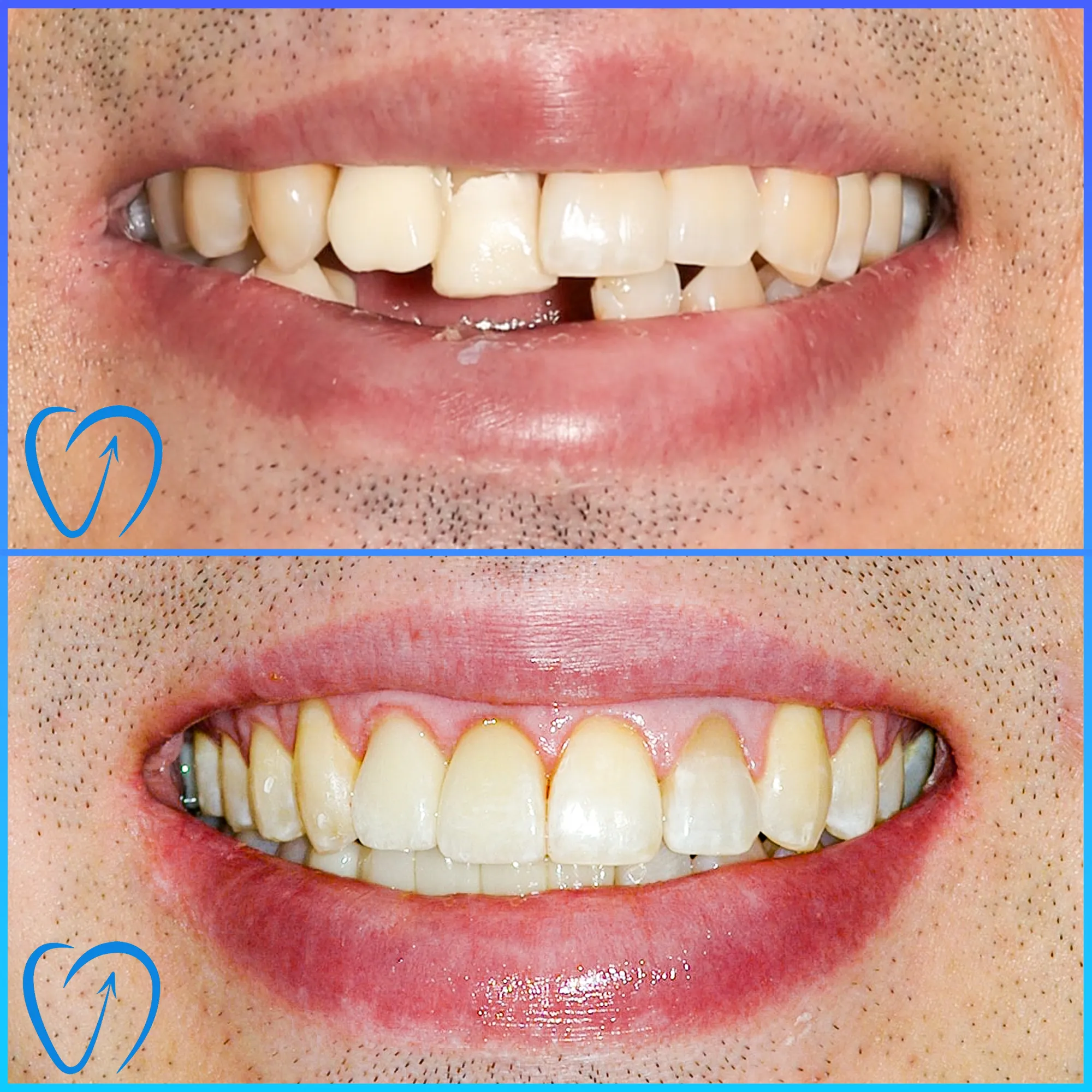 caz clinic implant dentar dupa fractura de maxilar EXCEDENT Bucuresti