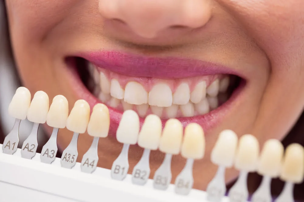 ce sunt fatetele dentare