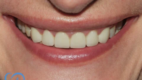 coroana dentara excedent stomatologie aviatiei dupa