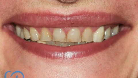 coroana dentara excedent stomatologie aviatiei inainte