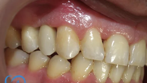 coroana dentara zirconiu clinica excedent dupa exemplu 2