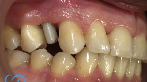 coroana dentara zirconiu clinica excedent inainte exemplu 2