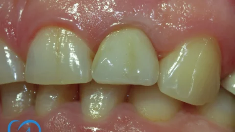 coroana dentara zirconiu implant dentar bucuresti dupa exemplu 4