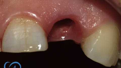 coroana dentara zirconiu implant dentar bucuresti inainte exemplu 4