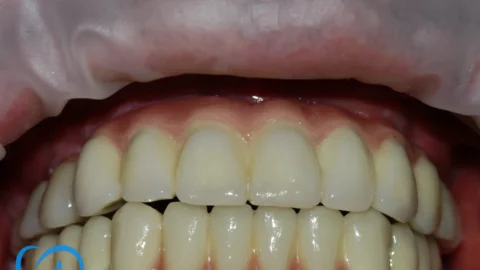 coroane dentare ceramice implant dentar excedent dupa exemplu 5