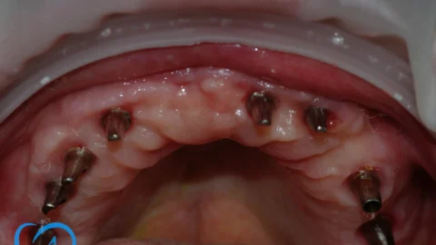 coroane dentare ceramice implant dentar excedent inainte exemplu 5