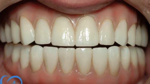 coroane dentare implant fast and fixed excedent