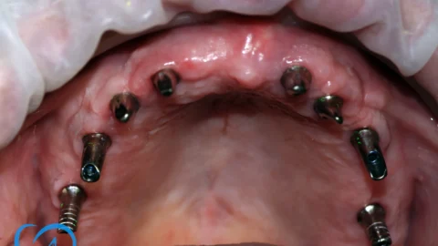 coroane pe implanturi dentare bucuresti excedent inainte exemplu 3
