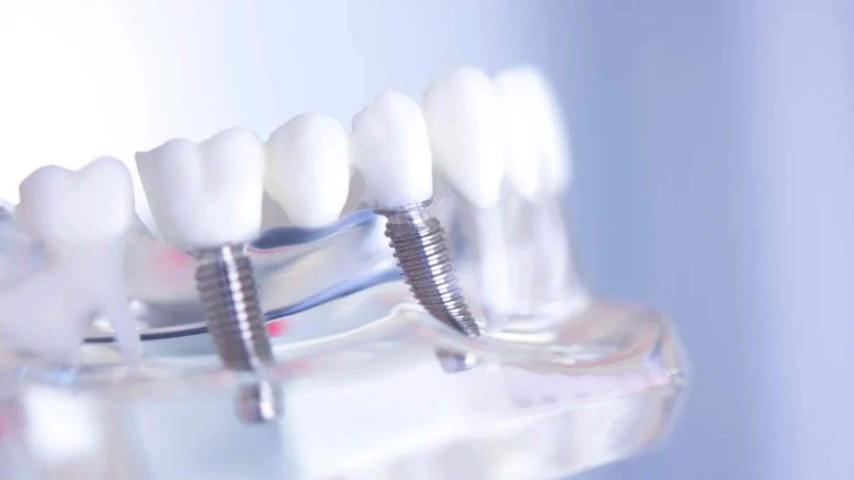 tratament implanturi dentare - de la disconfort la incredere implanturile dentare moderne