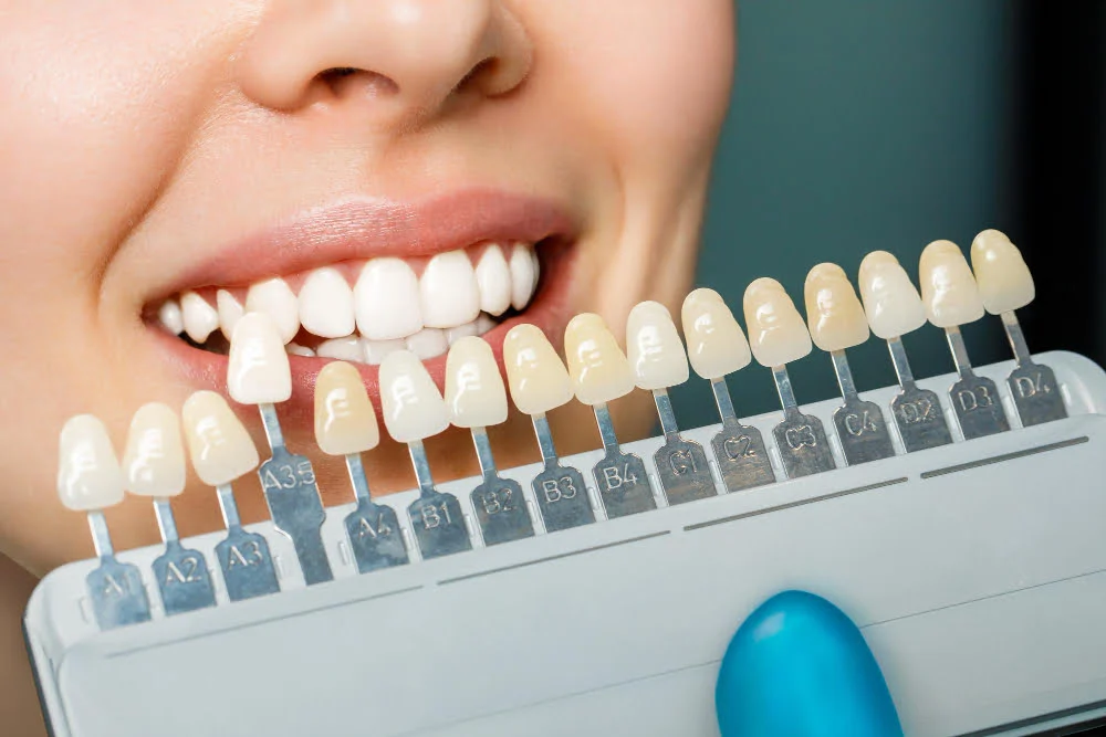durata de viata fatete dentare