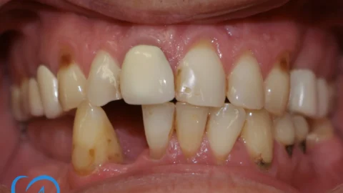 implant dentar bucuresti sector 6 punte 4 dinti inainte exemplu 6