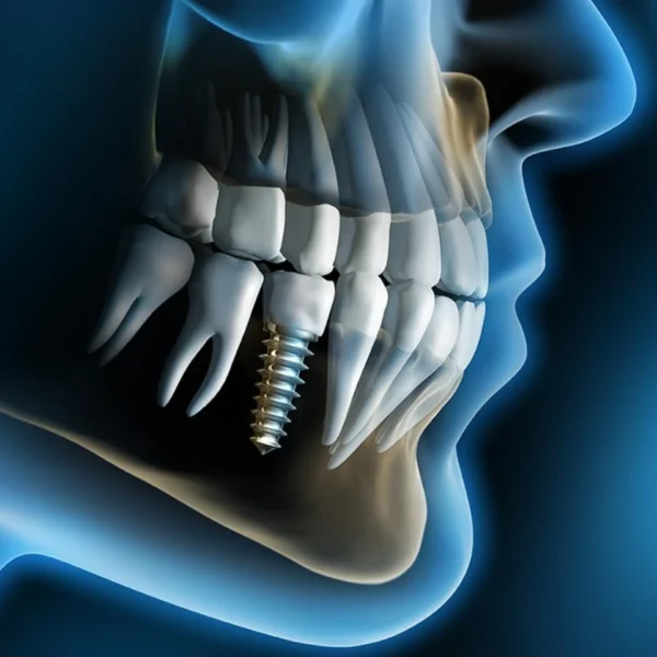 implant dentar clinica dentara excedent in bucuresti 000