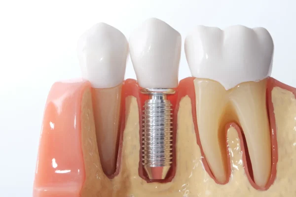 implant dentar clinica dentara excedent in bucuresti 002