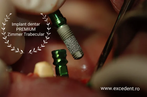 implant dentar clinica dentara excedent in bucuresti 006