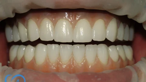 implant dentar excedent fast and fixed coroane zirconiu