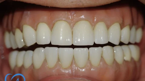 implant dentar fast and fixed coroane dentare zirconiu excedent