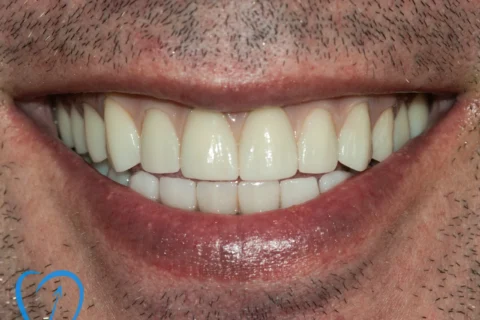 implant dentar parodontoza clinica excedent bucuresti dupa