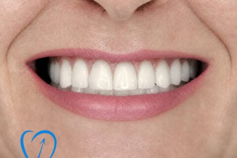 implant dentar zambet final caz 1 clinica excedent