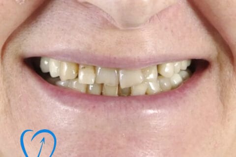 implant dentar zambet initial caz 1 clinica excedent