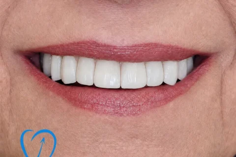 implant dentar zambet mg final clinica excedent
