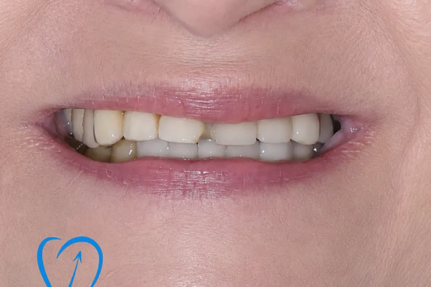 implant dentar zambet mg initial clinica excedent