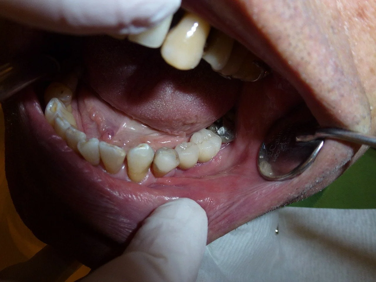 simptome retractie gingivala