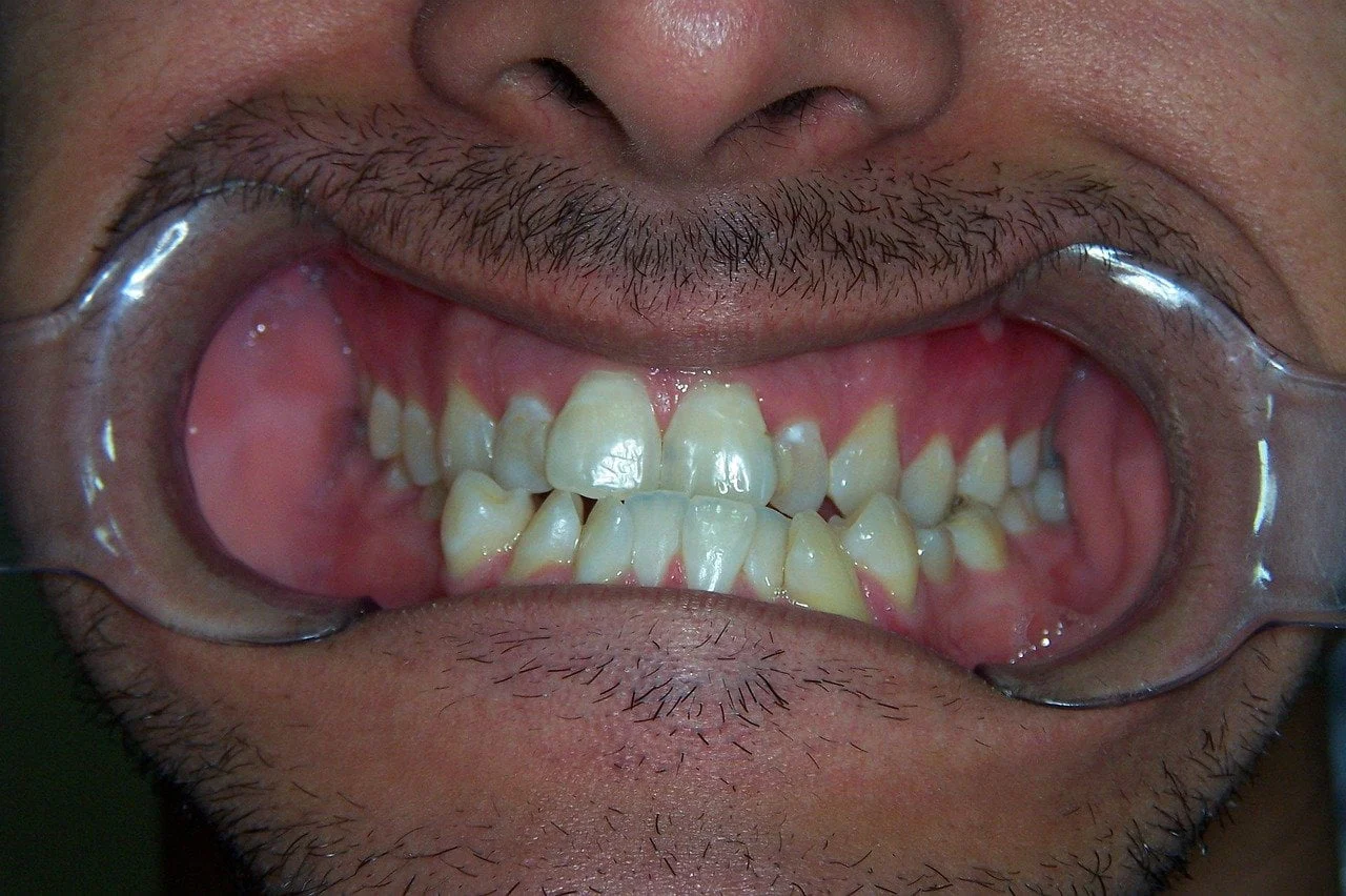 stadii retractii gingivale retragerea gingiilor prezinta 4 stadii