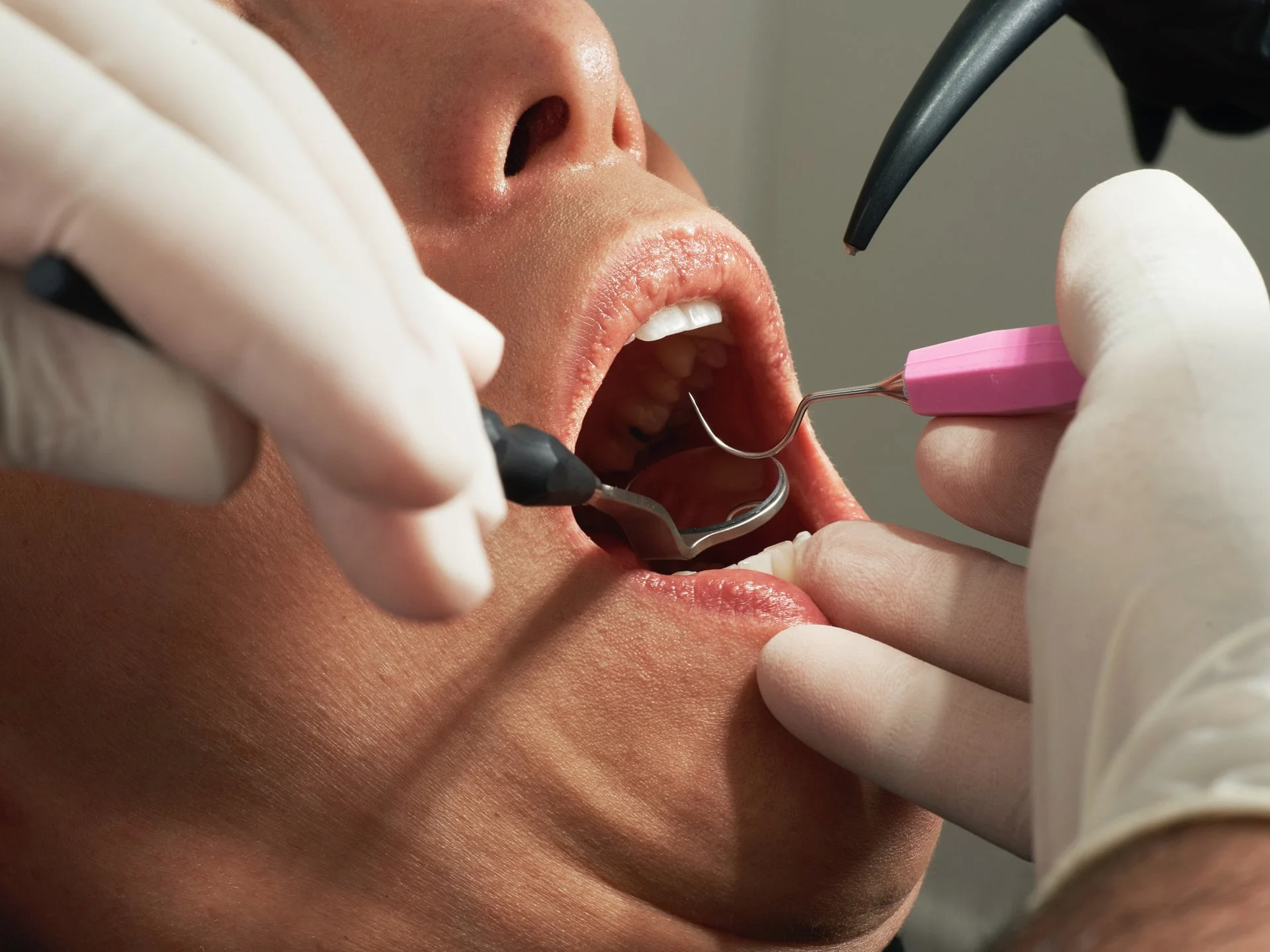 tratarea retractiei gingivale cu interventii chirurgicale